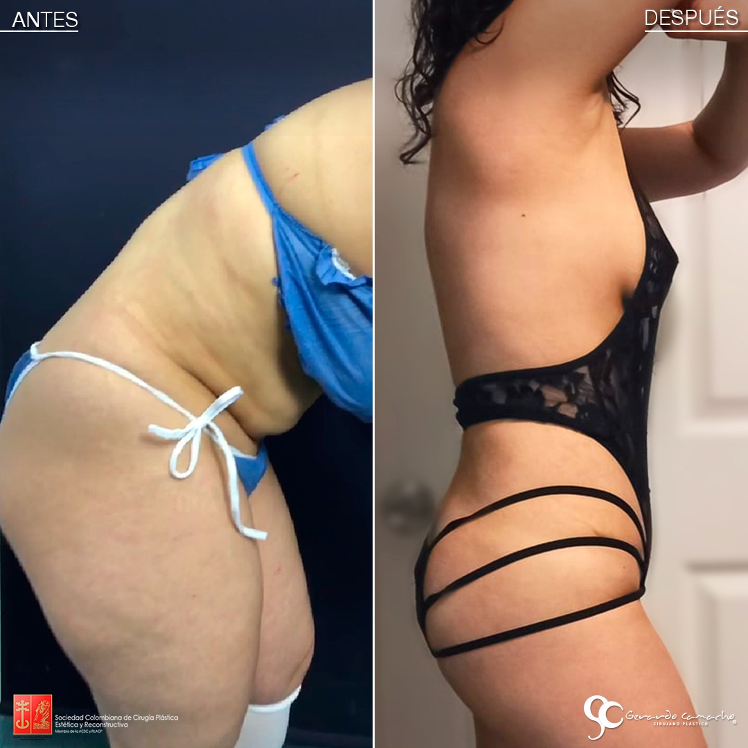 Resultados naturales de abdominoplastia en Bogotá